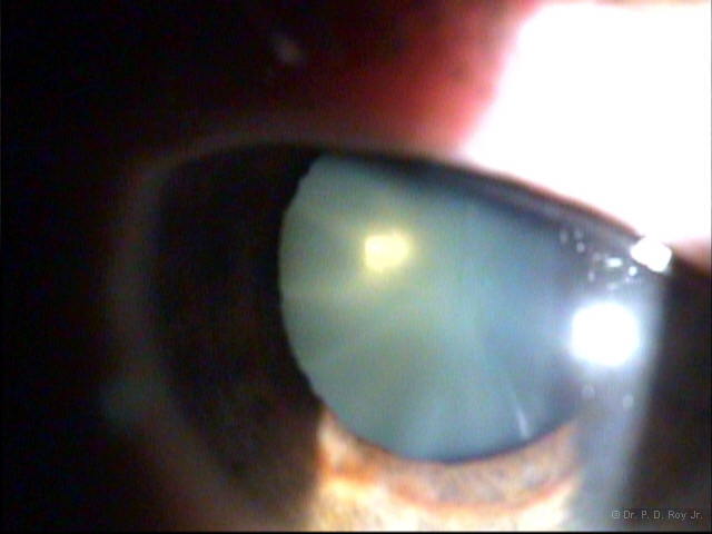 dr-roy-coosa-eye-Cataract
