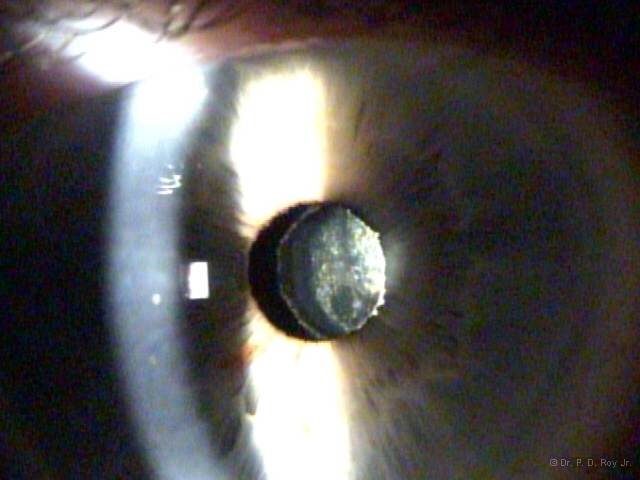 dr-roy-coosa-eye-Posterior Capsular Opacification (after cataract)