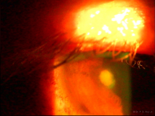 dr-roy-coosa-eye-Ulcer