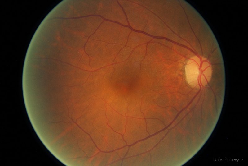 Dr-Roy-Coosa-Eye-Retina Detachment Repaired-1