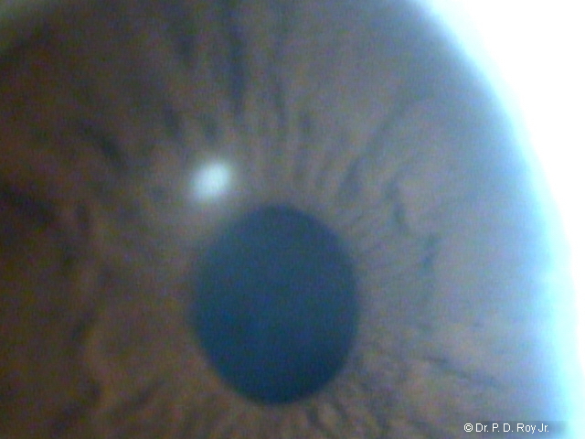 dr-roy-coosa-eye-Bacteria-Corneal-ulcer